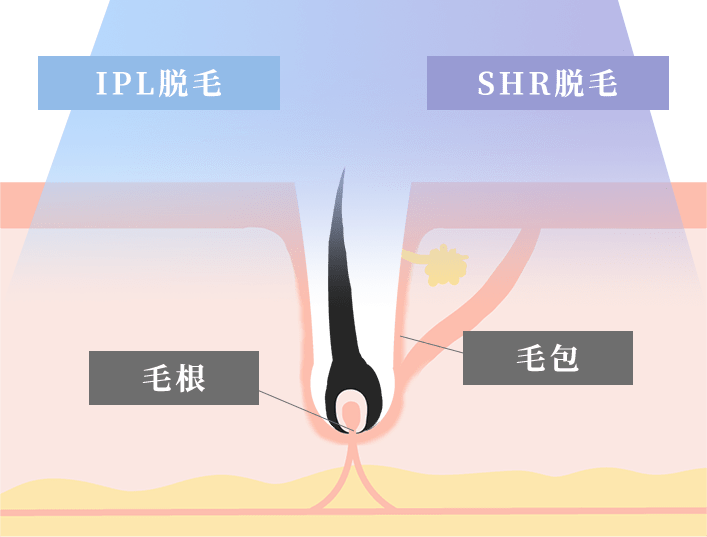 IPL脱毛・SHR脱毛・毛根・毛包